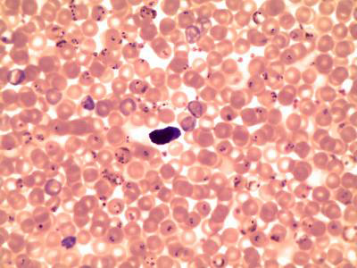  Global Leaders Call for More Tropical Disease R&D, Treatment