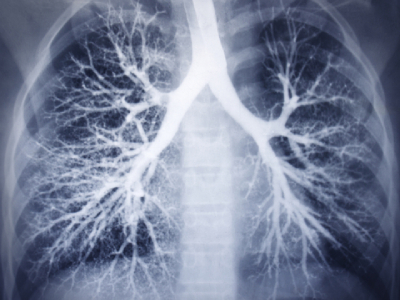  FDA Accepts Xcovery’s NDA for Ensartinib