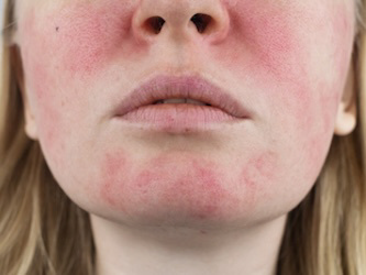 Journey Gets FDA Nod for Rosacea Capsules
