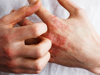 Rapt Terminates Immunology Drug Following FDA Hold