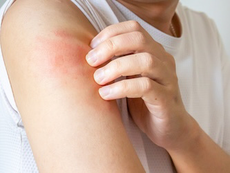 GSK Oral Drug Improves PBC Itch in Phase 3 Trial